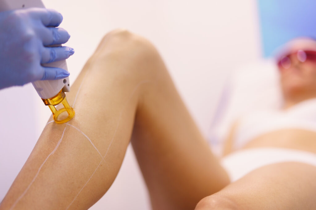 female swimmer having laser hair removal on legs after learning that competitive swimming and Laser hair removal go hand in hand